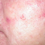 basal_carcinoma_2