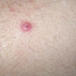 basal_carcinoma_3