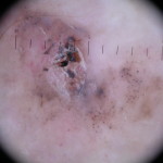 basal_cell_carcinoma_1_dermoscopy