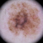 melanoma1_dermoscopy