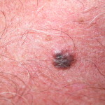 melanoma1_with_naked_eye_1